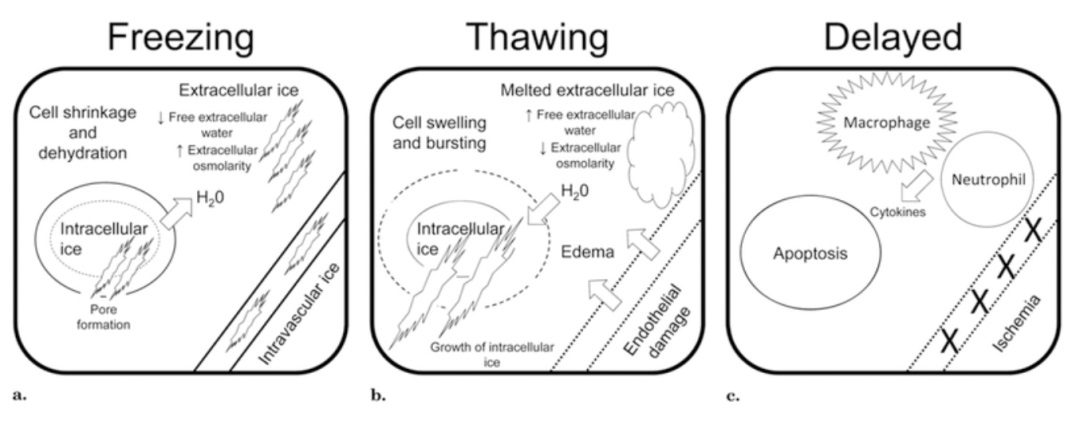 腫瘤治療界的「高冷之花」——腫瘤微創(chuàng)冷凍消融，國(guó)產(chǎn)替代設(shè)備空間巨大